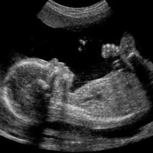 2D ultrasound Calgary showing baby’s heartbeat on monitor